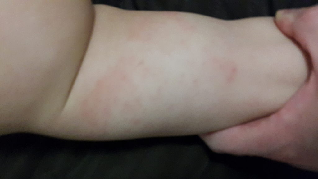 Problemy skórne - alergia Rumpla